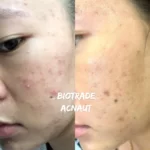 Hình ảnh Thực Tế Review Combo Giảm Mụn Viêm Mủ Biotrade Acnaut - 1Store.vn