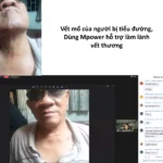 Vết Sẹo Mổ Của Người Bị Tiểu đường Dùng Mpower Hỗ Trợ - 1Store.vn