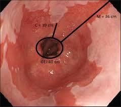 20211230_101511_916963_trao-nguoc-da-day-t-max-1800x1800-1 Trào ngược dạ dày thực quản có thể gây biến chứng thực quản Barrett